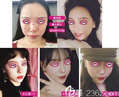 呼和浩特大韓整形鼻綜合效果圖