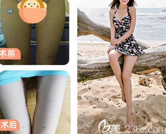 呼和浩特大韓整形醫(yī)院大腿吸脂對(duì)比圖