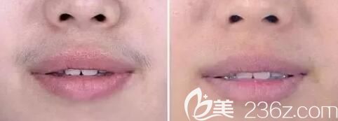 永州博美脫唇毛真人<span style=