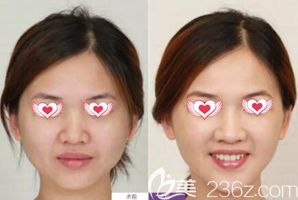 注射瘦臉真人前后<span style=