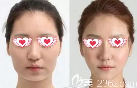 玻尿酸填充面部真人<span style=