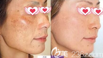 祛斑真人前后<span style=