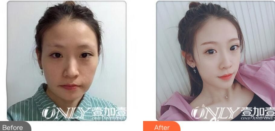 合肥壹加壹金王怎么樣？面部線雕提升案例效果來驗證