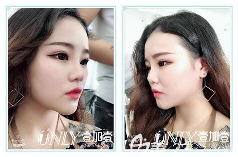 找合肥壹加壹金王做玻尿酸隆下巴+隆鼻+注射瘦臉后第2天