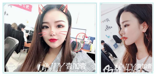 金王做隆鼻、隆下巴+瘦臉術(shù)后第7天效果圖