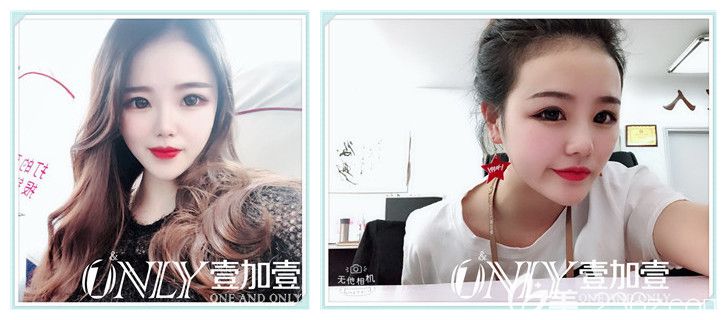 壹加壹整形注射瘦臉術(shù)后16天效果圖