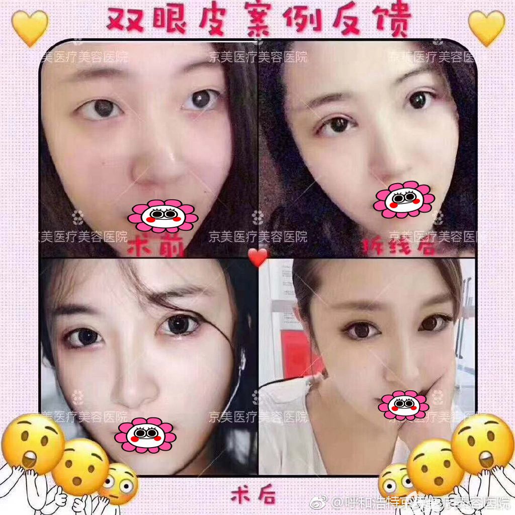 呼和浩特京美朱京成雙眼皮案例