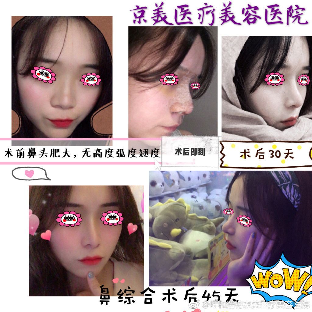 呼和浩特京美整形隆鼻效果圖