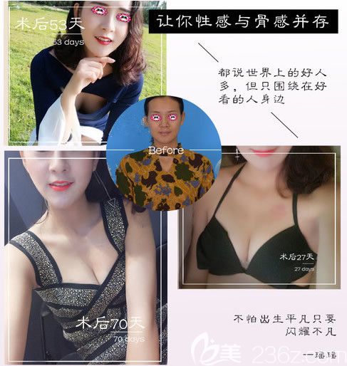 京美整形醫(yī)院隆胸前后對比圖
