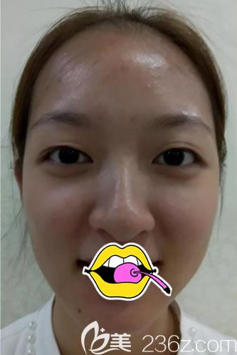 在<!--<i data=20240703-sp></i>-->做雙眼皮手術(shù)前 在<!--<i data=20240703-sp></i>-->做雙眼皮手術(shù)前