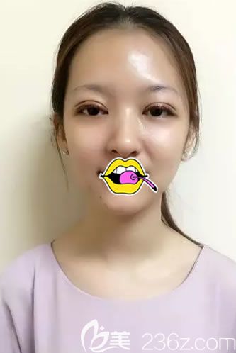 剛做完雙眼皮綜合手術(shù)照片 剛做完雙眼皮綜合手術(shù)照片