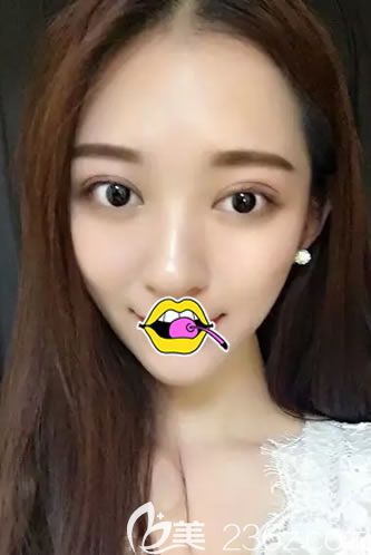 在<!--<i data=20240703-sp></i>-->做雙眼皮10天恢復(fù)照 在<!--<i data=20240703-sp></i>-->做雙眼皮10天恢復(fù)照