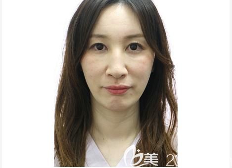 宇津木流醫(yī)院宇津木龍一面雕手術(shù)前 宇津木流醫(yī)院宇津木龍一面雕手術(shù)前