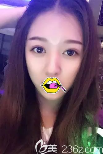 <!--<i data=20240703-sp></i>-->譚成林做雙眼皮30天效果 <!--<i data=20240703-sp></i>-->譚成林做雙眼皮30天效果