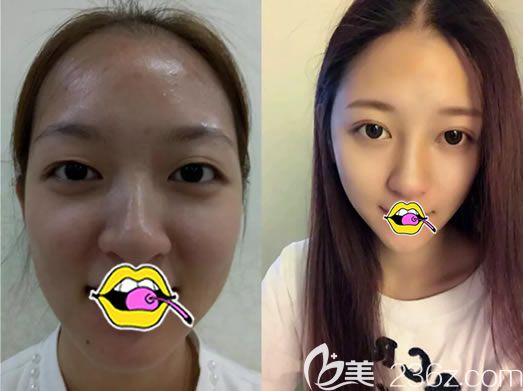 <!--<i data=20240703-sp></i>-->譚成林雙眼皮案例對比圖 <!--<i data=20240703-sp></i>-->譚成林雙眼皮案例對比圖