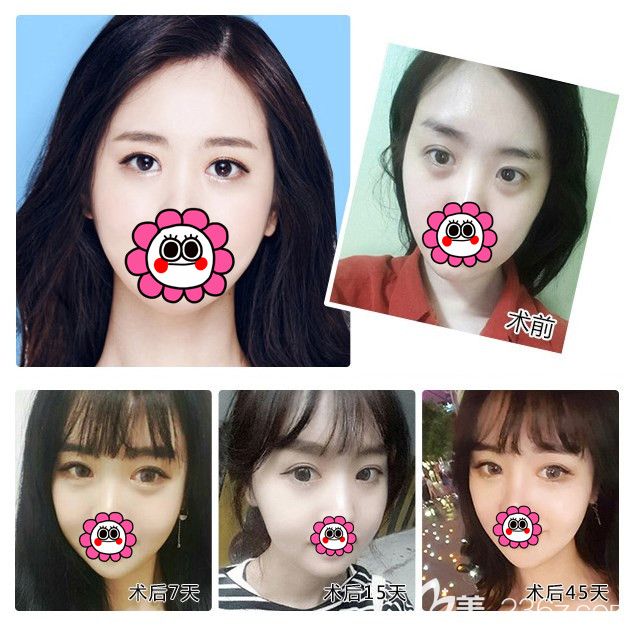 在南通維多利亞做V·純韓無(wú)痕祛眼袋手術(shù)案例 在南通維多利亞做V·純韓無(wú)痕祛眼袋手術(shù)案例