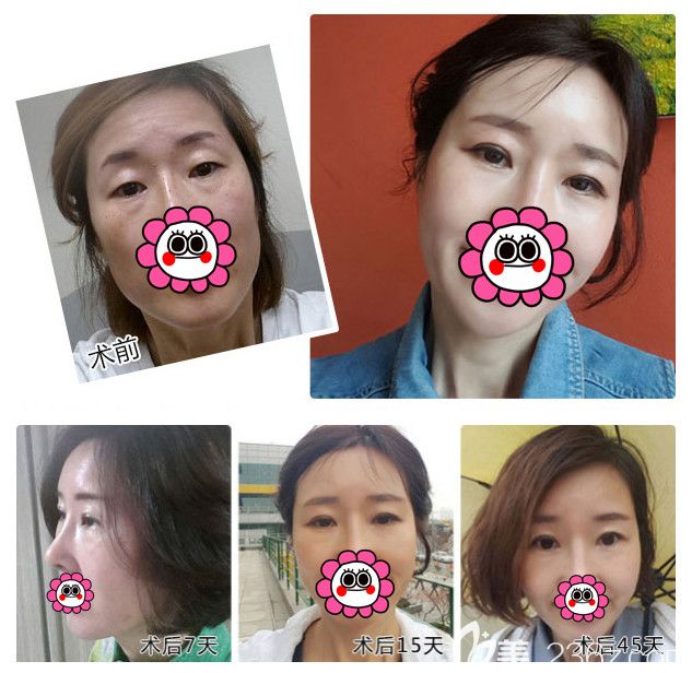 聽說南通4A級醫(yī)院維多利亞做去眼袋效果不錯(cuò)，母女倆到院一起改善了遺傳大眼袋