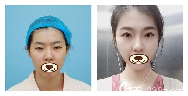 濰坊華美整形任傳琦醫(yī)生眼綜合+假體隆鼻真實(shí)案例對比照