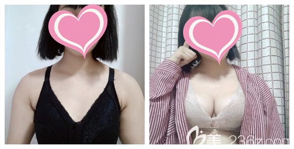 濰坊華美整形美容醫(yī)院任傳琦醫(yī)生自體脂肪豐胸真實(shí)術(shù)后對比照