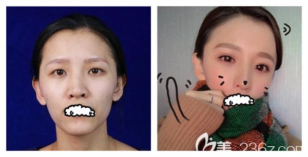 濰坊華美整形美容醫(yī)院玻尿酸面部填充術(shù)后18天效果對比