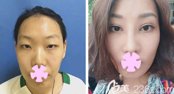 玉林時光整形全切雙眼皮加開眼角術后30天恢復效果