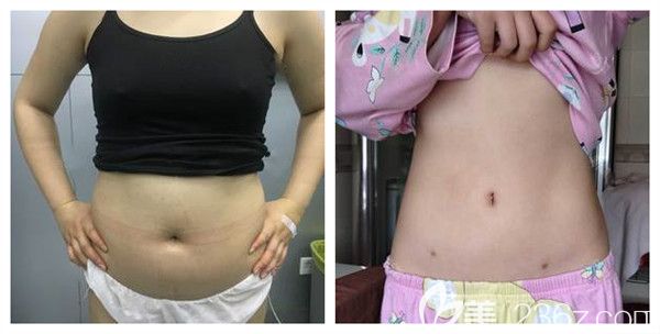 濰坊華美整形美容醫(yī)院腰腹吸脂術(shù)后21天對比圖
