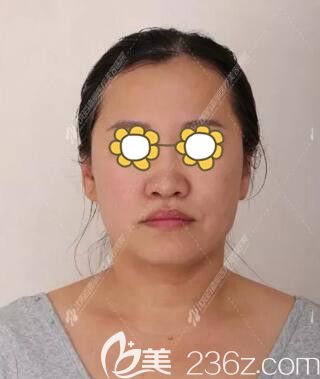 面部埋線提升術(shù)前照 面部埋線提升術(shù)前照