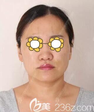 做面部埋線提升術(shù)后第三天效果 做面部埋線提升術(shù)后第三天效果