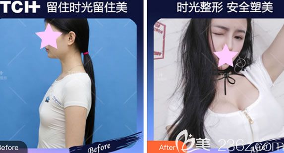 玉林時光整形曼托假體隆胸案例