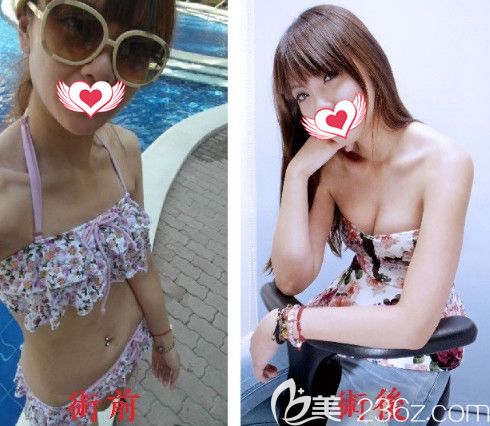 陳俊光院長(zhǎng)做自體脂肪豐胸案例 陳俊光院長(zhǎng)做自體脂肪豐胸案例