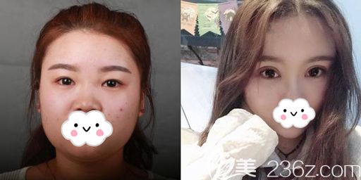 西安高一生做切開雙眼皮術(shù)后恢復(fù)效果