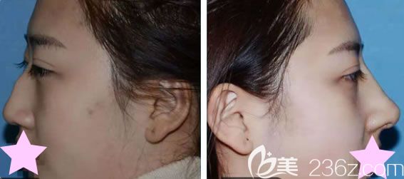 玉林時光整形陳鴻主任鼻綜合案例