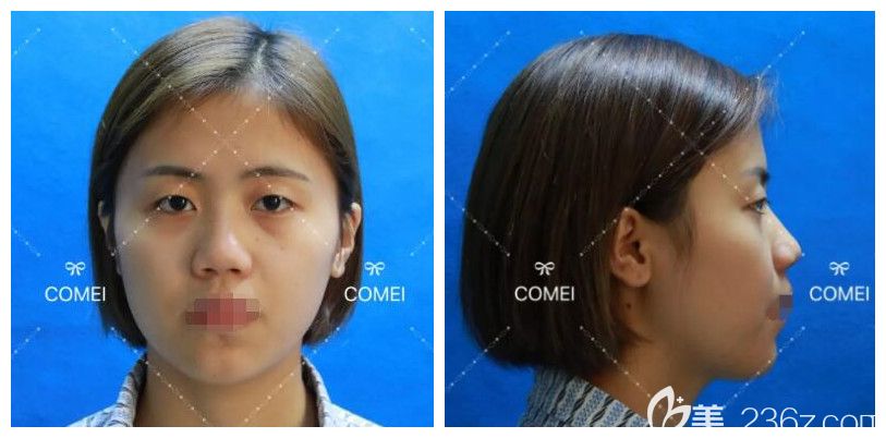 從正面和側面南通康美醫(yī)生設計綜合面部整形方案 從正面和側面南通康美醫(yī)生設計綜合面部整形方案