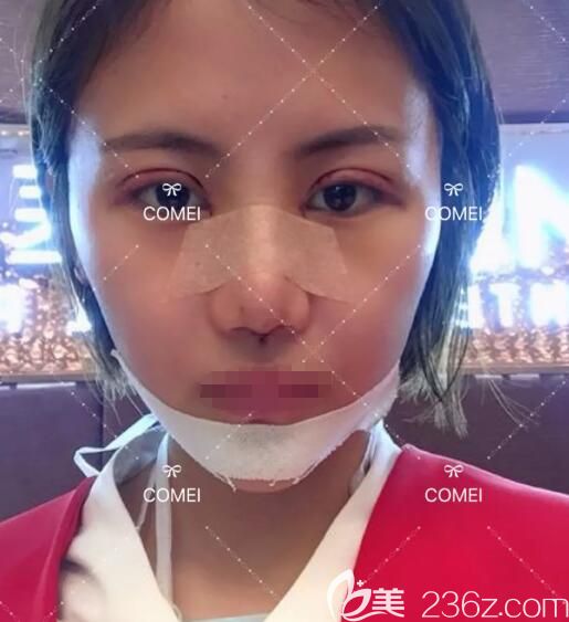 找康美醫(yī)生做切開雙眼皮+硅膠隆鼻+假體墊下巴術后即刻 找康美醫(yī)生做切開雙眼皮+硅膠隆鼻+假體墊下巴術后即刻