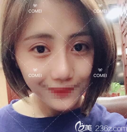 到南通康美一下子做了切開雙眼皮+硅膠隆鼻+假體墊下巴迎來立體精致的五官