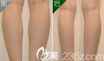 蘇亞美聯(lián)臣整形醫(yī)院瘦小腿案例 蘇亞美聯(lián)臣整形醫(yī)院瘦小腿案例
