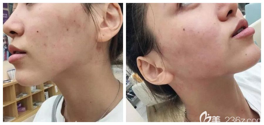 找合肥壹加壹楊義做臉部熱提拉后即刻效果圖