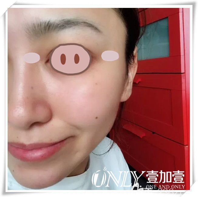 楊義面部熱提拉治療后第7天恢復(fù)情況