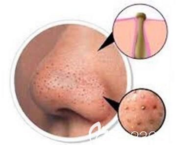 臉上長(zhǎng)黑頭怎么去除？