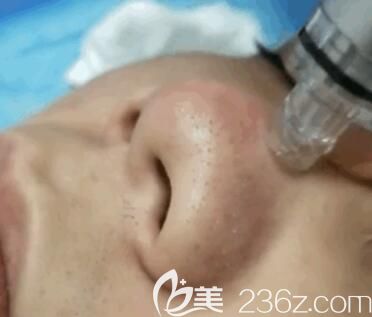 小氣泡皮膚深層清潔儀去除黑頭