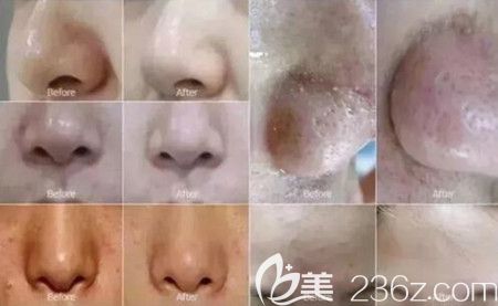 小氣泡去黑頭前后效果對(duì)比