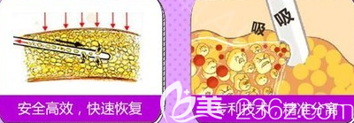 吸脂示意圖