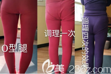 O型腿改善案例圖