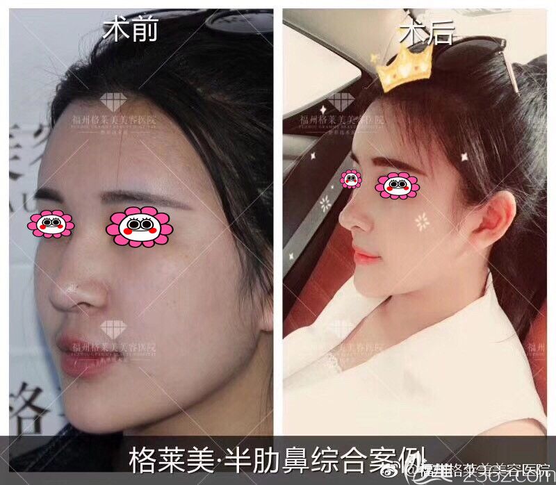 福州格萊美鄭少雄隆鼻變化圖