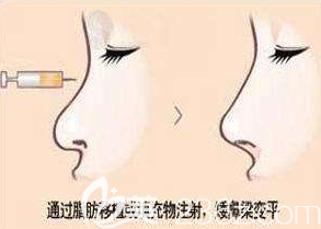 自體脂肪注射隆鼻不好塑形
