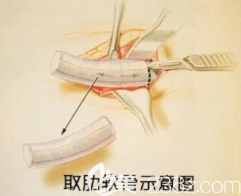 軟骨隆鼻兩年內(nèi)會(huì)發(fā)生吸收