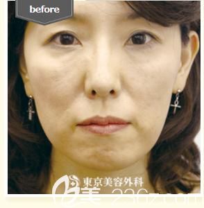 木村幸志伊做埋線提拉前 木村幸志伊做埋線提拉前