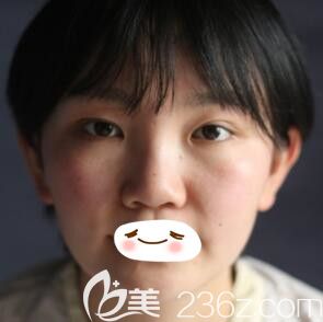 肋軟骨隆鼻+美杜莎內(nèi)眼角術(shù)前照 肋軟骨隆鼻+美杜莎內(nèi)眼角術(shù)前照