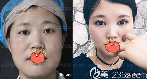 永康光大整形郭院長(zhǎng)雙眼皮<span style= 永康光大整形郭院長(zhǎng)雙眼皮<span style=