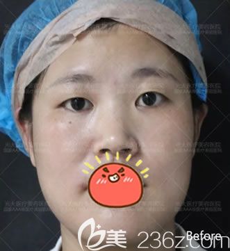 在永康光大做雙眼皮前照片 在永康光大做雙眼皮前照片